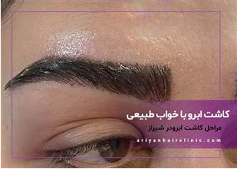 مراحل کاشت ابرو با خواب طبیعی